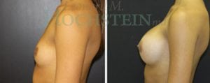 Breast Augmentation Patient