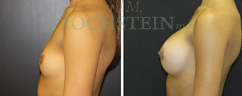 Breast Augmentation Patient