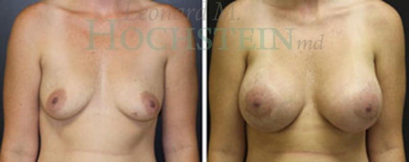 Breast Augmentation Patient