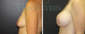 Breast Augmentation Patient
