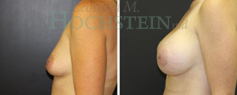 Breast Augmentation Patient