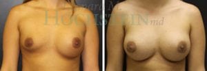 Breast Augmentation Patient