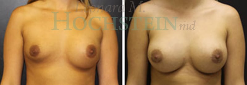 Breast Augmentation Patient