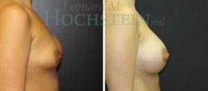 Breast Augmentation Patient
