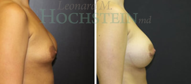 Breast Augmentation Patient