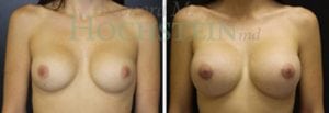 Breast Augmentation Patient