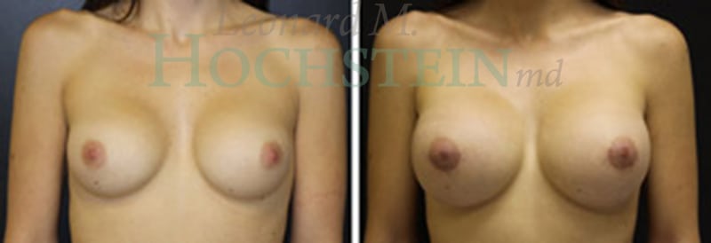 Breast Augmentation Patient