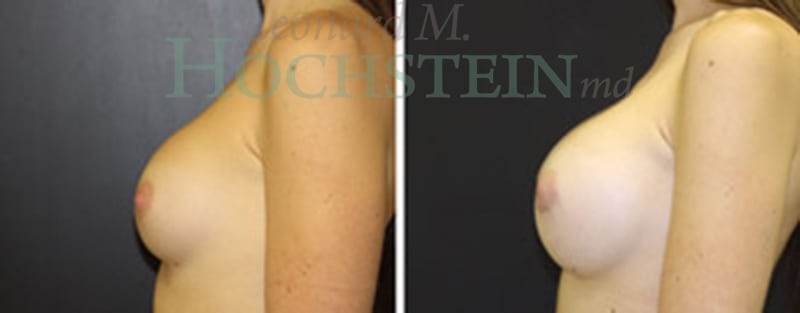 Breast Augmentation Patient