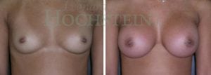 Breast Augmentation Patient
