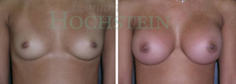 Breast Augmentation Patient