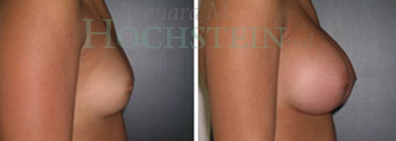 Breast Augmentation Patient