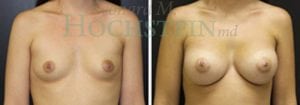 Breast Augmentation Patient