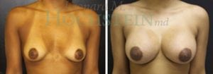 Breast Augmentation Patient