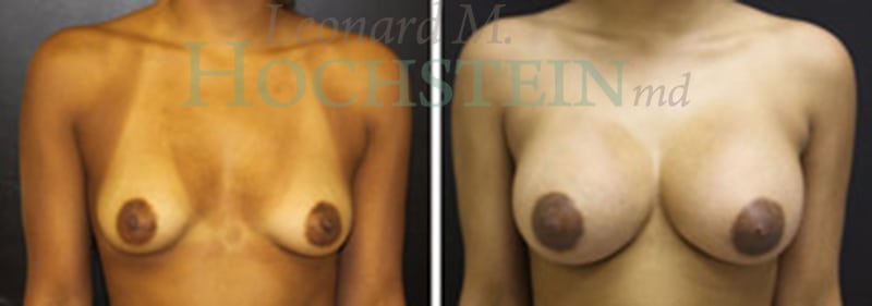 Breast Augmentation Patient
