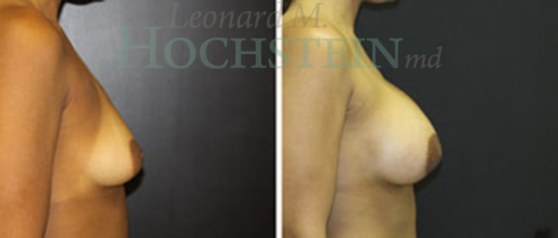 Breast Augmentation Patient