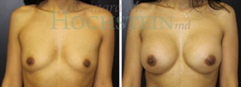 Breast Augmentation Patient