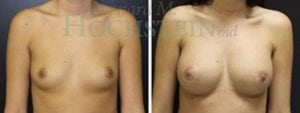 Breast Augmentation Patient