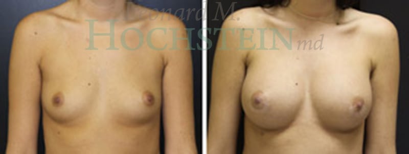 Breast Augmentation Patient