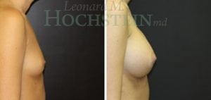 Breast Augmentation Patient