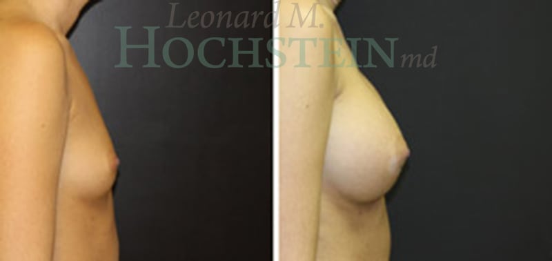 Breast Augmentation Patient