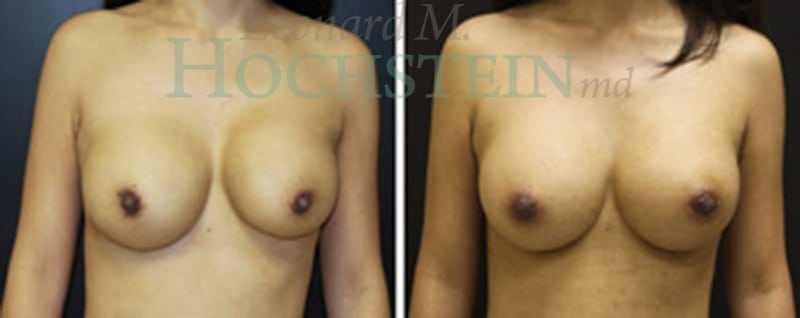 Breast Augmentation Patient