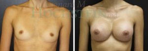 Breast Augmentation Patient