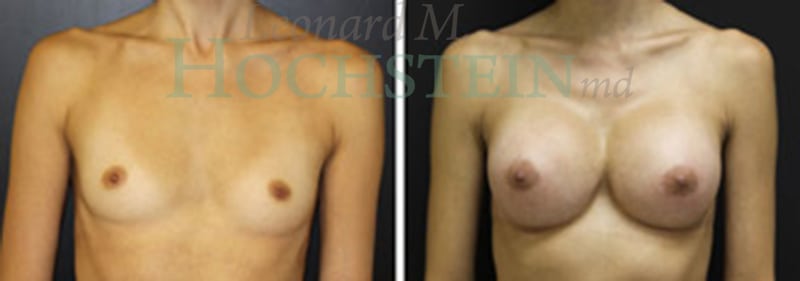 Breast Augmentation Patient