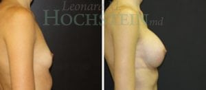 Breast Augmentation Patient