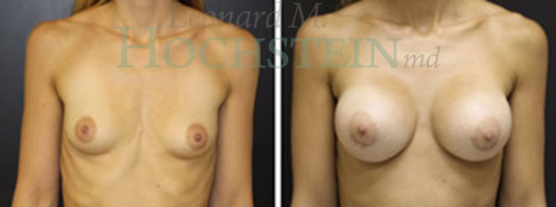 Breast Augmentation Patient