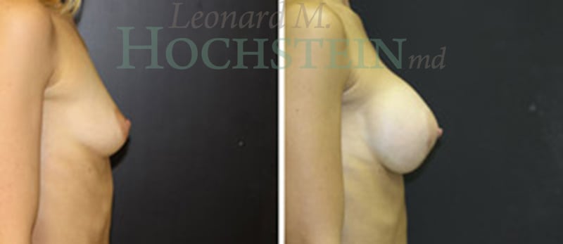 Breast Augmentation Patient