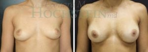Breast Augmentation Patient