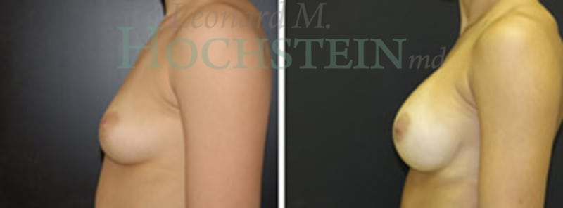 Breast Augmentation Patient