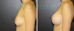 Breast Augmentation Patient