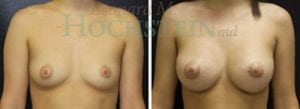 Breast Augmentation Patient