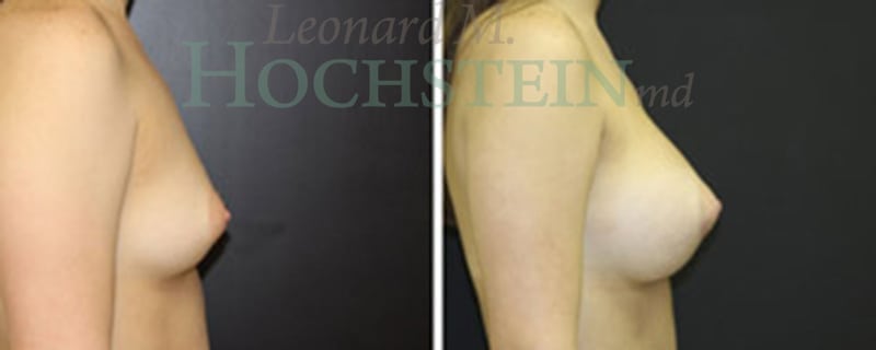 Breast Augmentation Patient