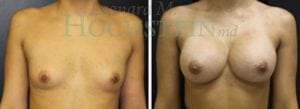 Breast Augmentation Patient