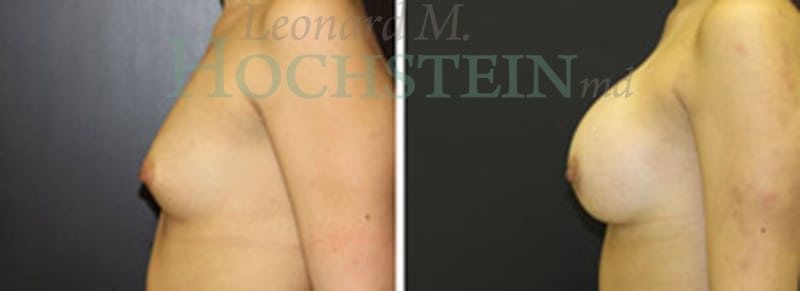 Breast Augmentation Patient