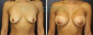 Breast Augmentation Patient