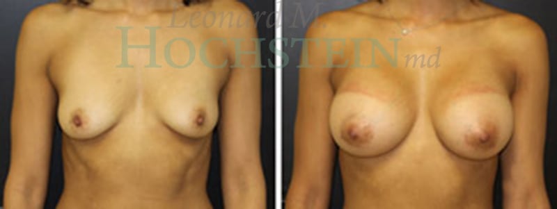Breast Augmentation Patient