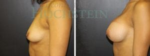 Breast Augmentation Patient