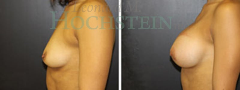 Breast Augmentation Patient