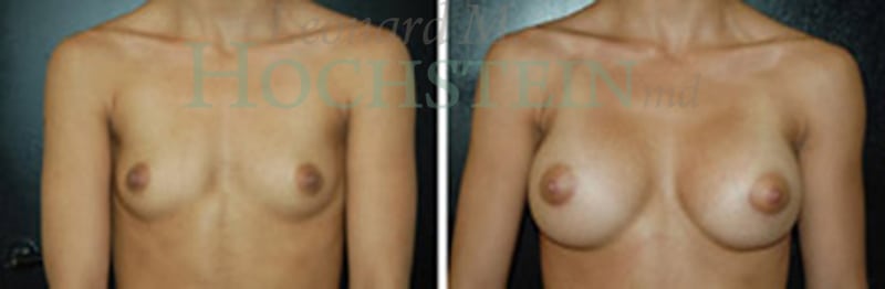 Breast Augmentation Patient