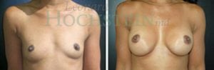 Breast Augmentation Patient