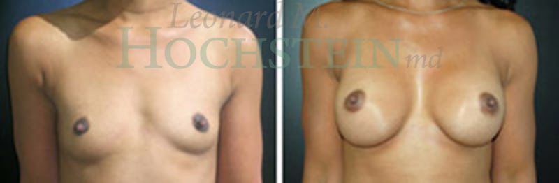 Breast Augmentation Patient