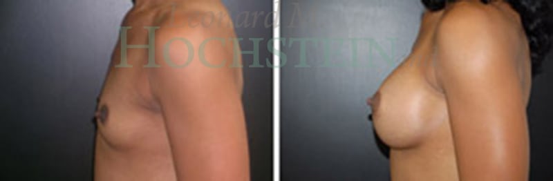 Breast Augmentation Patient