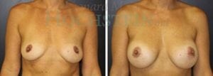 Breast Augmentation Patient