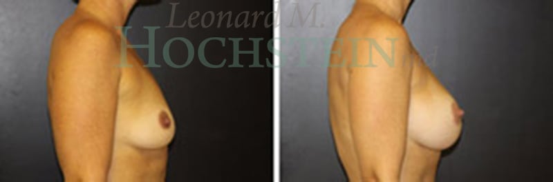 Breast Augmentation Patient