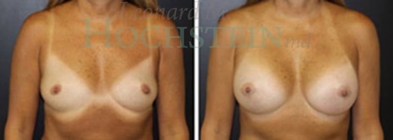Breast Augmentation Patient