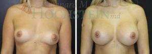 Breast Augmentation Patient