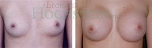 Breast Augmentation Patient